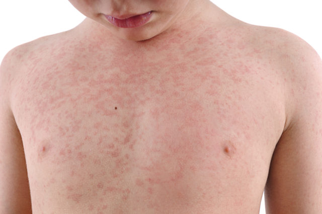 Infant Rashes